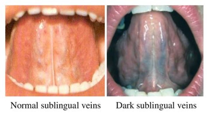 ¿Son normales las venas oscuras debajo de la lengua? – Celebrity.fm