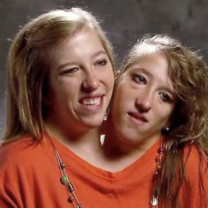 Are the conjoined twins separated Abby and Brittany?