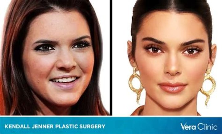 Did Kendall Jenner have braces? – Celebrity.fm – #1 Official Stars, Business & People Network, Wiki, Success story, Biography & Quotes